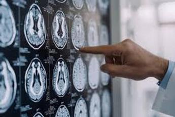 Malattia di Parkinson, ok in Europa a formulazione orale Ld/Cd a rilascio modificato