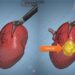 Modelli tridimensionali biomimetici del cancro al rene di un paziente per chirurgia robotica sempre più precisa