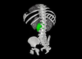 Chirurgia su misura, al Bambino Gesù di Roma rimosso complesso neuroblastoma a bimba di 1 anno