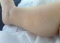 Dermatite atopica, Aifa estende rimborso di upadacitinib dai 12 anni di età