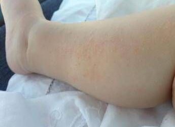 Dermatite atopica, Aifa estende rimborso di upadacitinib dai 12 anni di età