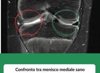 Tornare a camminare con un trapianto: a 12 anni riceve un menisco da donatore deceduto, intervento in artroscopia a Treviglio (Bg)