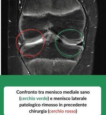Tornare a camminare con un trapianto: a 12 anni riceve un menisco da donatore deceduto, intervento in artroscopia a Treviglio (Bg)