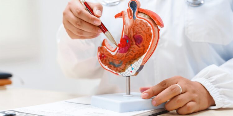 Cancro allo stomaco avanzato, nuova terapia riduce del 42% il rischio di morte ﻿