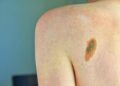 Melanoma, la firma mutazionale del cancro potrà cambiare la cura﻿