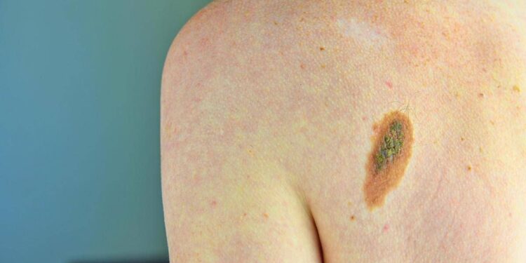Melanoma, la firma mutazionale del cancro potrà cambiare la cura﻿